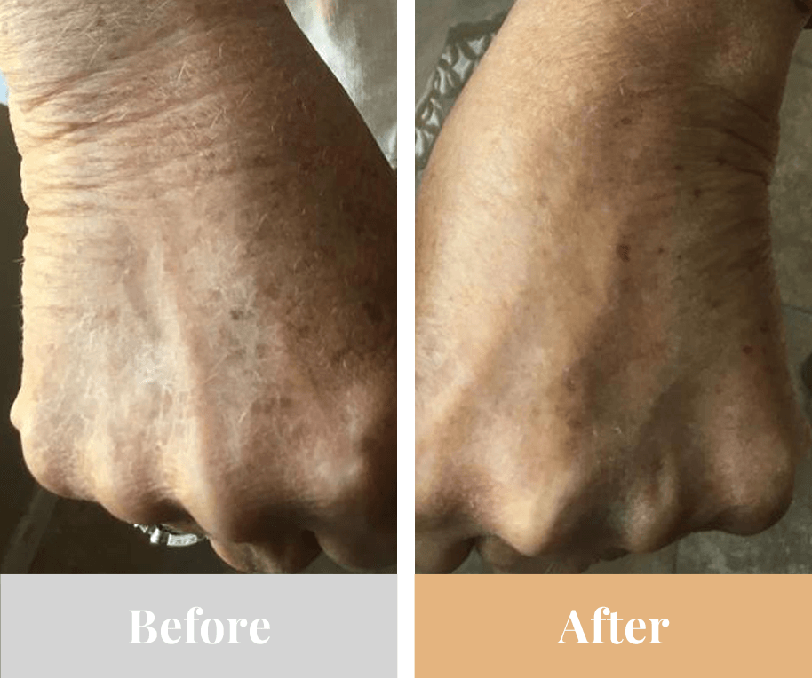 Omnilux Contour GLOVE