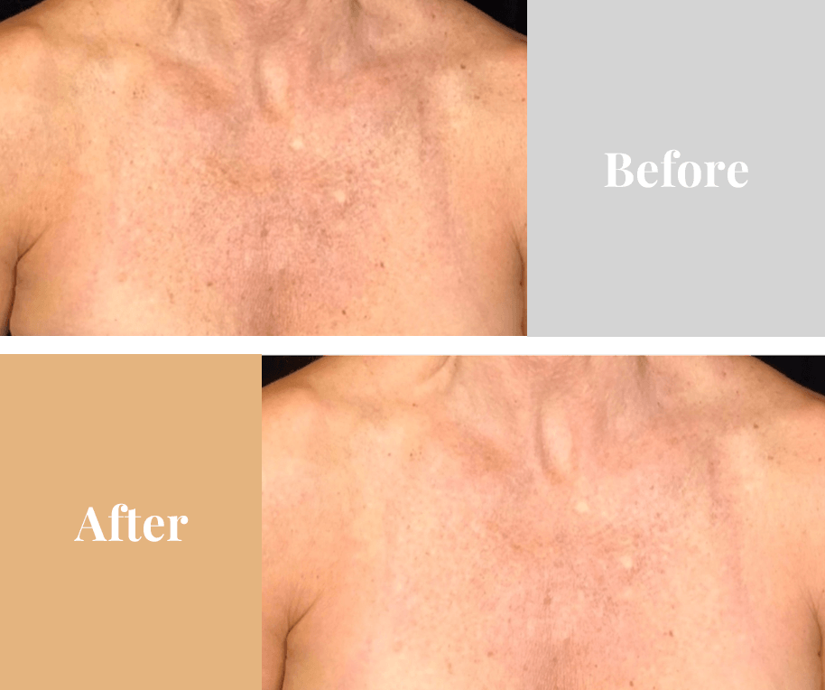 Omnilux Contour NECK & DÉCOLLETÉ